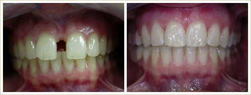 Closing front gap