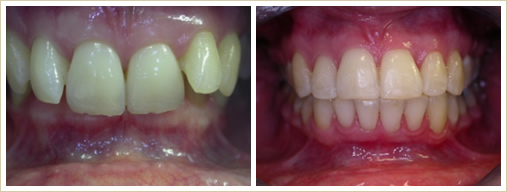 Front upper teeth cover too much the lower teeth