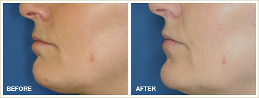 dermal fillers