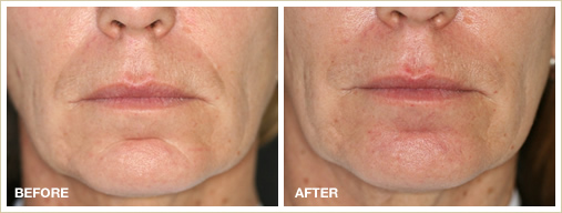 dermal fillers