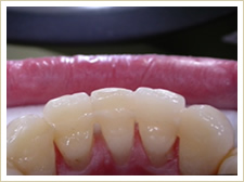 Clear bonded retainer