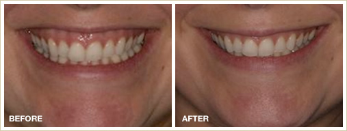 Wrinkle treatment