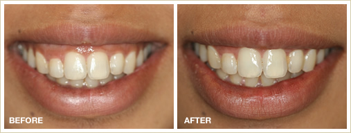 Wrinkle treatment