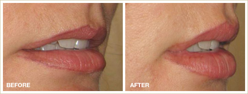 dermal fillers