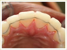 Metallic bonded retainer