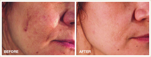 skin peel treatment